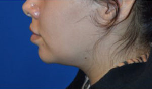 Chin Liposuction Case 5428 Before Photo Chin Liposuction