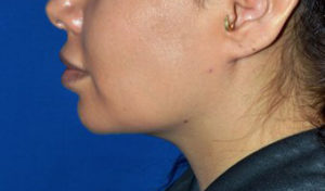 Chin Liposuction Case 5428 After Photo Chin Liposuction