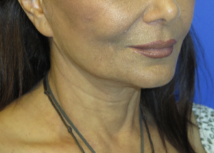 FACEology Lift / Neck Lift Case 5754 Before Photo FACEology Lift / Neck Lift
