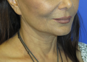 FACEology Lift / Neck Lift