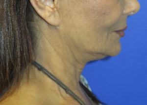 FACEology Lift / Neck Lift Case 5754 Before Photo FACEology Lift / Neck Lift