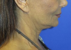 FACEology Lift / Neck Lift