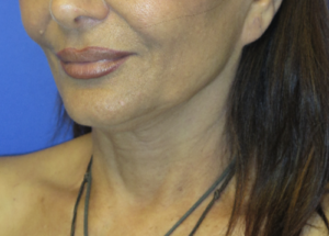 FACEology Lift / Neck Lift Case 5754 Before Photo FACEology Lift / Neck Lift