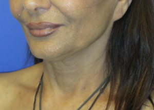 FACEology Lift / Neck Lift