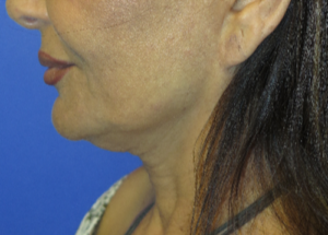 FACEology Lift / Neck Lift Case 5754 Before Photo FACEology Lift / Neck Lift