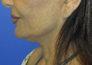 FACEology Lift / Neck Lift