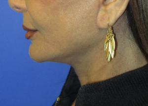 FACEology Lift / Neck Lift Case 5754 After Photo FACEology Lift / Neck Lift
