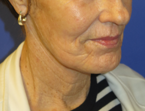 FACEology Lift / Neck Lift Case 5736 After Photo FACEology Lift / Neck Lift