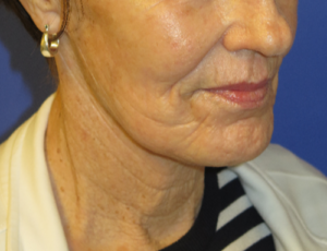 FACEology Lift / Neck Lift