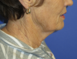 FACEology Lift / Neck Lift