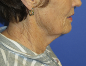 FACEology Lift / Neck Lift Case 5736 Before Photo FACEology Lift / Neck Lift