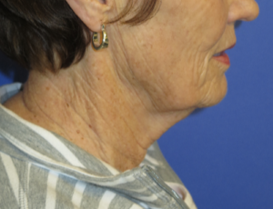 FACEology Lift / Neck Lift