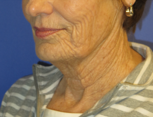 FACEology Lift / Neck Lift Case 5736 Before Photo FACEology Lift / Neck Lift