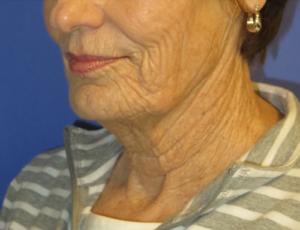 FACEology Lift / Neck Lift