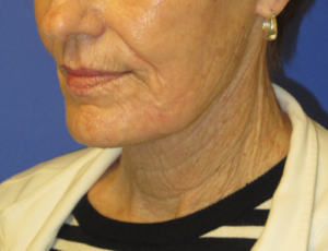 FACEology Lift / Neck Lift Case 5736 After Photo FACEology Lift / Neck Lift