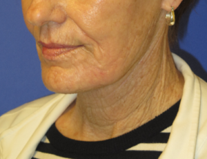 FACEology Lift / Neck Lift