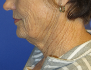 FACEology Lift / Neck Lift Case 5736 Before Photo FACEology Lift / Neck Lift