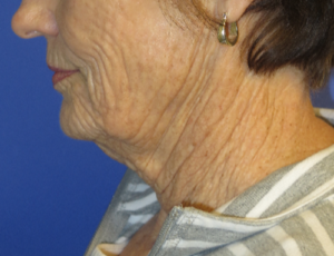 FACEology Lift / Neck Lift