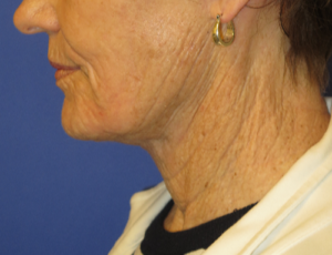 FACEology Lift / Neck Lift Case 5736 After Photo FACEology Lift / Neck Lift