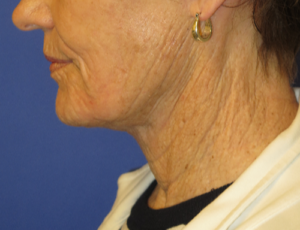 FACEology Lift / Neck Lift