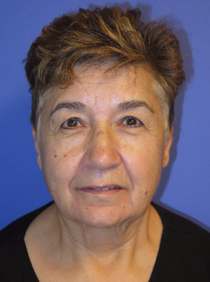 FACEology Lift / Neck Lift Case 5615 Before Photo FACEology Lift / Neck Lift