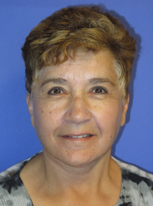 FACEology Lift / Neck Lift Case 5615 After Photo FACEology Lift / Neck Lift