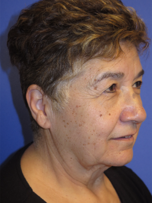 FACEology Lift / Neck Lift Case 5615 Before Photo FACEology Lift / Neck Lift