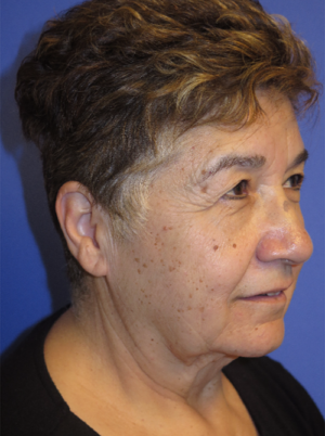 FACEology Lift / Neck Lift