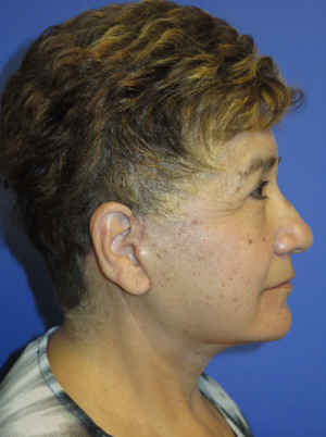 FACEology Lift / Neck Lift Case 5615 After Photo FACEology Lift / Neck Lift