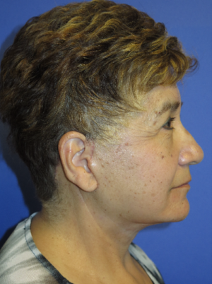 FACEology Lift / Neck Lift