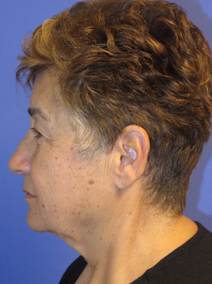 FACEology Lift / Neck Lift Case 5615 Before Photo FACEology Lift / Neck Lift
