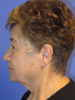 FACEology Lift / Neck Lift