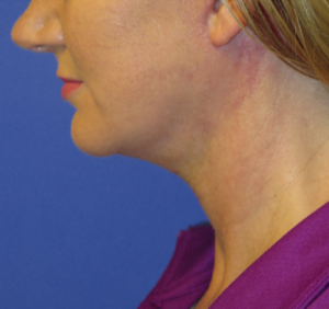 FACEology Lift / Neck Lift Case 5638 After Photo FACEology Lift / Neck Lift