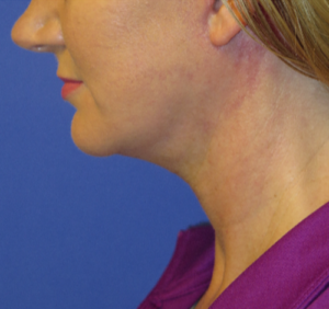 FACEology Lift / Neck Lift