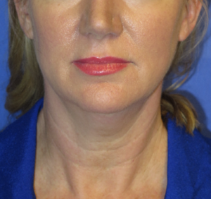 FACEology Lift / Neck Lift Case 5638 Before Photo FACEology Lift / Neck Lift