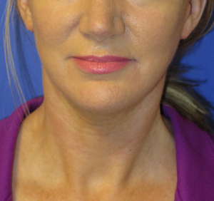 FACEology Lift / Neck Lift Case 5638 After Photo FACEology Lift / Neck Lift
