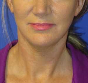 FACEology Lift / Neck Lift