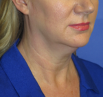 FACEology Lift / Neck Lift