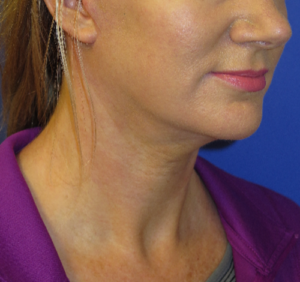 FACEology Lift / Neck Lift Case 5638 After Photo FACEology Lift / Neck Lift
