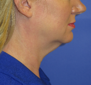 FACEology Lift / Neck Lift Case 5638 Before Photo FACEology Lift / Neck Lift