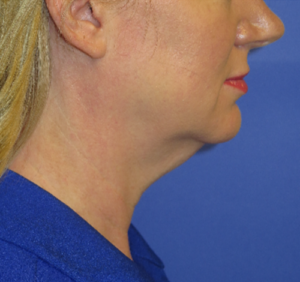 FACEology Lift / Neck Lift