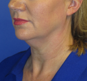 FACEology Lift / Neck Lift Case 5638 Before Photo FACEology Lift / Neck Lift