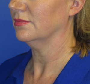 FACEology Lift / Neck Lift