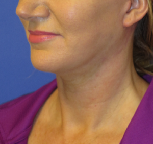 FACEology Lift / Neck Lift Case 5638 After Photo FACEology Lift / Neck Lift