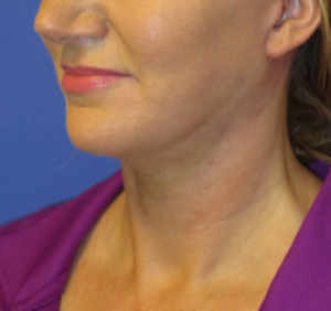 FACEology Lift / Neck Lift