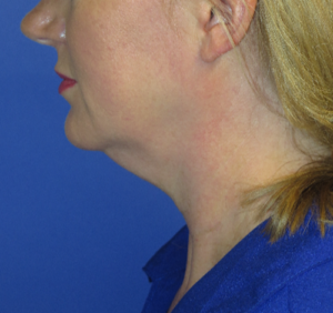 FACEology Lift / Neck Lift Case 5638 Before Photo FACEology Lift / Neck Lift