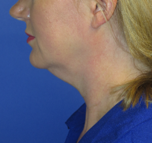 FACEology Lift / Neck Lift