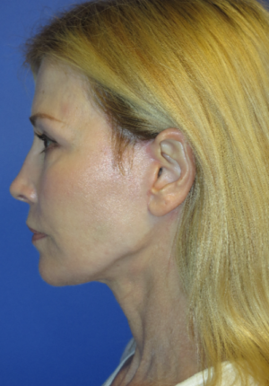 FACEology Lift / Neck Lift Case 5670 After Photo FACEology Lift / Neck Lift