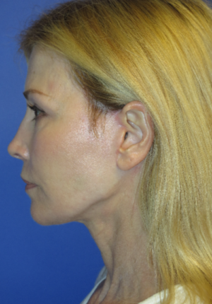 FACEology Lift / Neck Lift