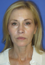 FACEology Lift / Neck Lift